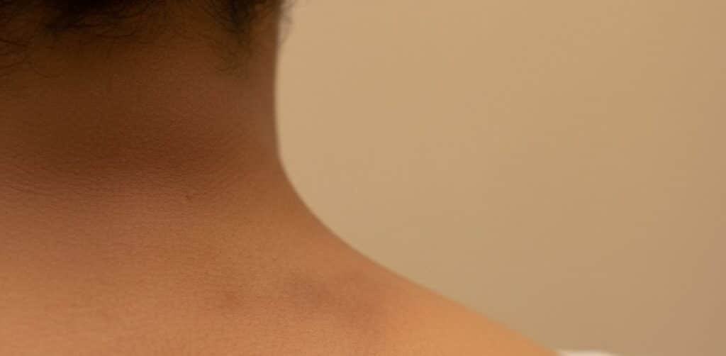 Darkened, velvety skin around the back of the neck, armpits, or knuckles
